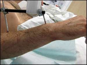 German doctors carry out complete double arm transplant